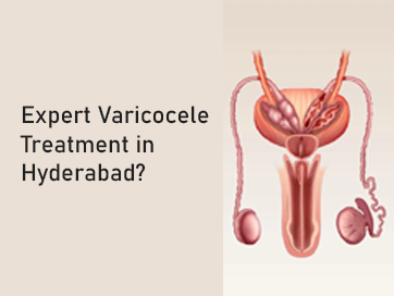 Expert Varicocele Treatment in Hyderabad What You Should Know